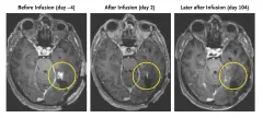 Cell therapy appears to shrink aggressive brain tumors