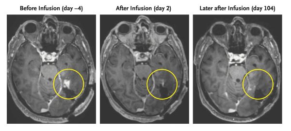 Cell therapy appears to shrink aggressive brain tumors