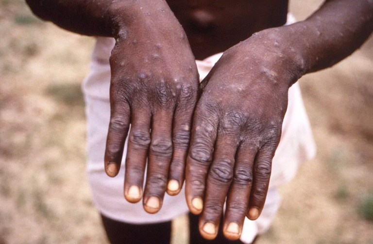 White House holds policy discussion over preparedness of monkeypox outbreaks