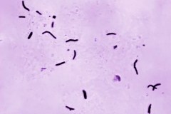 Kansas City area grapples with large tuberculosis outbreak