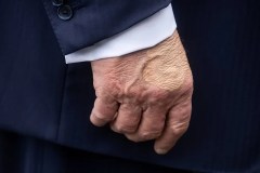 Trump diagnosed with chronic venous insufficiency condition, White House reveals