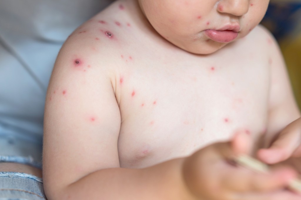 NextImg:CDC to change measles and chickepox vaccine due to seizures