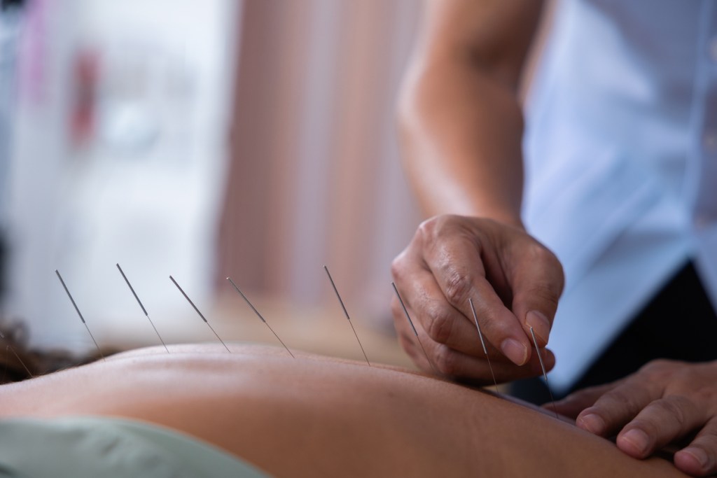 NextImg:Acupuncture gets boost in NIH-funded study