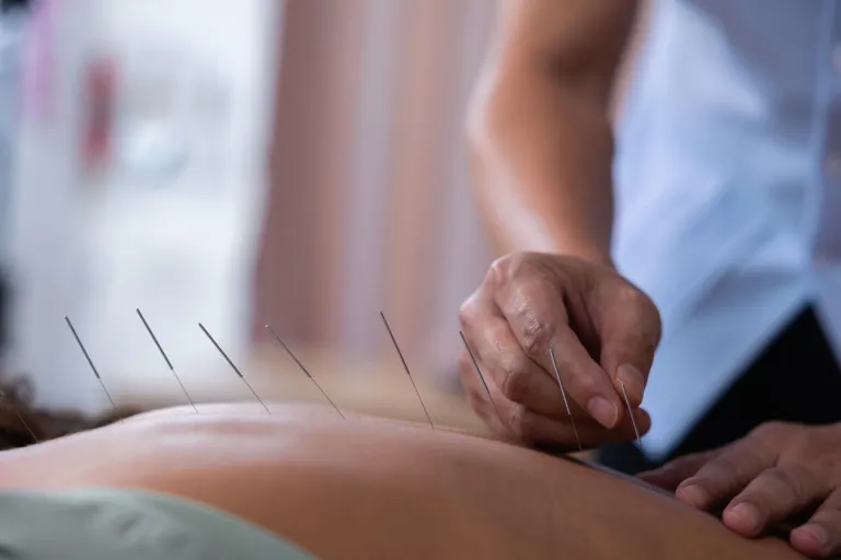 Acupuncturist stock image