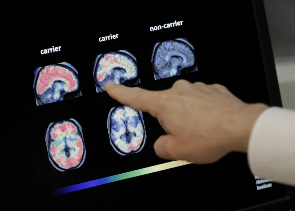 America leads on Alzheimer’s innovation. China actually takes it seriously