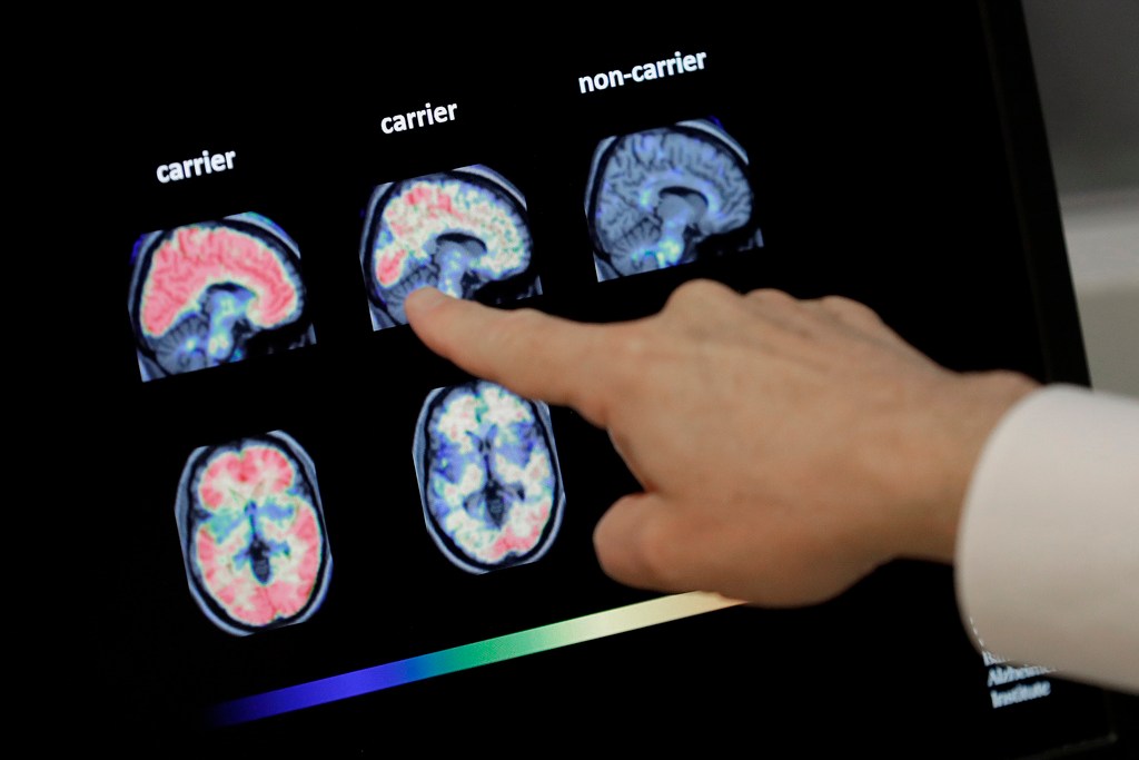 NextImg:Voters like candidates supporting war on Alzheimer's: Poll