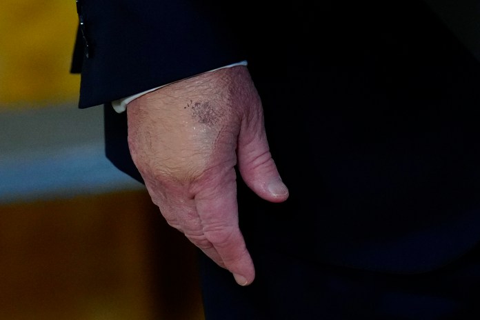 President Donald Trump's right hand is seen during a Mother's Day event for members of the military, Wednesday, May 6, 2026, in the East Room of the White House, in Washington. (AP Photo/Jacquelyn Martin)